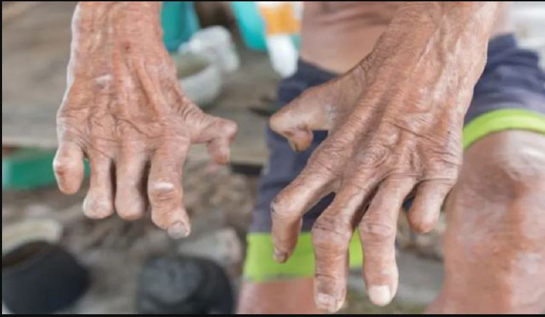 आज ७१औँ विश्व कुष्ठरोग दिवस : सबैभन्दा बढी कुष्ठरोगी कुन प्रदेशमा छन् ?